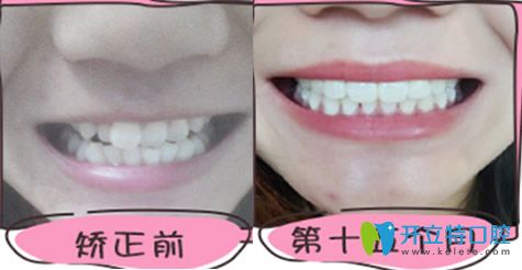 <!--<i data=20240703-sp></i>-->伊爾意口腔牙列擁擠不齊矯正案例前后對(duì)比圖