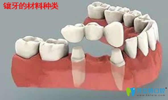 全面介紹鑲牙多少錢一顆及能用醫(yī)保嗎？