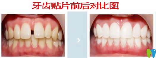 牙齒貼片前后對(duì)比圖