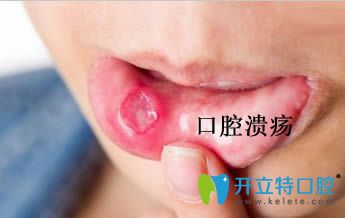 開立特引起復(fù)發(fā)性口腔潰瘍原因是什么