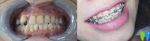 北京誠(chéng)之康口腔正畸怎么樣？來(lái)看對(duì)比圖