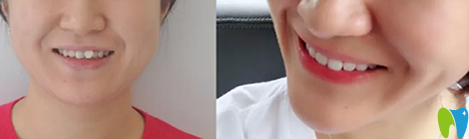 在優(yōu)植口腔牙齒矯正對(duì)比圖