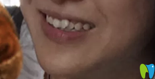 長沙優(yōu)植口腔牙齒矯正前