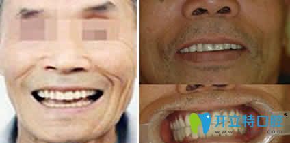 老爸在北京美冠塔口腔做即刻種植牙后的照片 老爸在北京美冠塔口腔做即刻種植牙后的照片