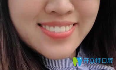 我在寧波恒美口腔做兔牙矯正1年的效果 我在寧波恒美口腔做兔牙矯正1年的效果