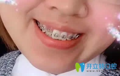 我在寧波恒美口腔做牙齒矯正第3個月照片 我在寧波恒美口腔做牙齒矯正第3個月照片