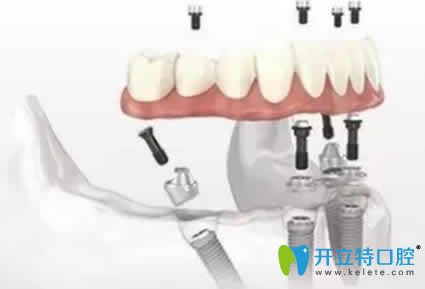 北京美冠塔口腔ALLON4種植牙圖 北京美冠塔口腔ALLON4種植牙圖