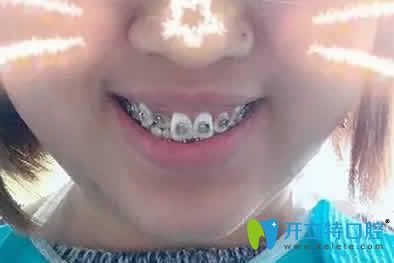 我在寧波恒美口腔做自鎖托槽牙齒矯正第3個月照片 我在寧波恒美口腔做自鎖托槽牙齒矯正第3個月照片