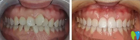 長沙優(yōu)植口腔牙齒矯正效果圖
