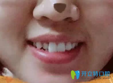 我在寧波恒美口腔做兔牙矯正后臉型變好看了 附前后對(duì)比照