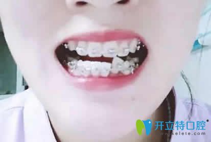 我在太原皓久口腔做金屬托槽牙齒矯正第9個(gè)月照片