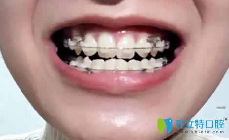 我在廈門天使口腔做虎牙矯正12個(gè)月照片