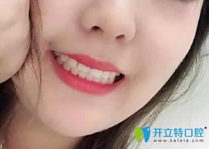 我在太原皓久齒科做牙齒矯正18個(gè)月效果