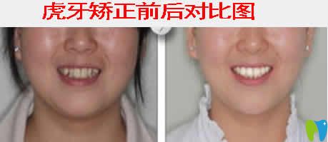 太原皓久口腔張磊醫(yī)生牙齒矯正案例效果圖 太原皓久口腔張磊醫(yī)生牙齒矯正案例效果圖