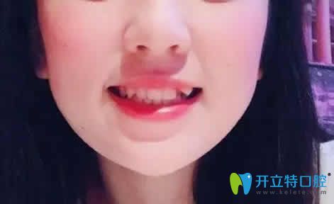 透露我在廈門天使口腔做虎牙矯正前后對(duì)比照片及親身經(jīng)歷