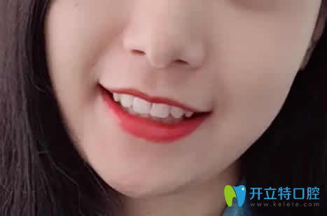 我在廈門天使口腔做牙齒矯正18個(gè)月照片