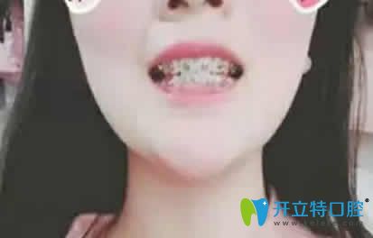 我在太原皓久口腔做牙齒矯正戴牙套第3個(gè)月照片
