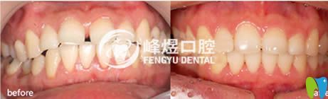 牙齒稀疏和門(mén)牙外翻矯正案例