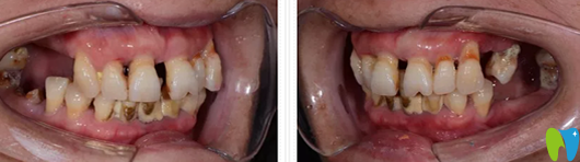 去鄭州未來口腔做牙齒種植前側(cè)面口腔照片