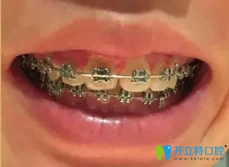 我在廣州偉聯(lián)口腔做自鎖托槽矯正第10個月照片 我在廣州偉聯(lián)口腔做自鎖托槽矯正第10個月照片