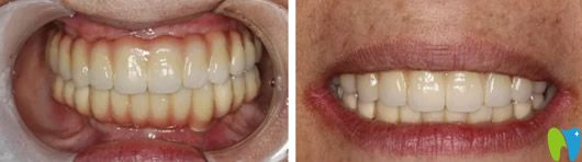 找鄭州美萊口腔歐陽秋玲做牙齒種植后圖