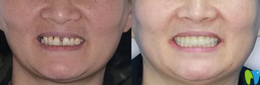 帶著媽媽去鄭州未來口腔做了種植牙 給大家說說她的感受