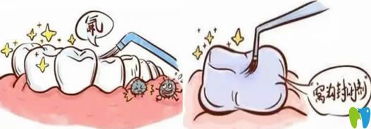 防蛀：兒童窩溝封閉和涂氟那個好?兩者的區(qū)別是什么?