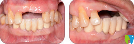 <!--<i data=20240703-sp></i>-->哪家種植牙好？來(lái)看<!--<i data=20240703-sp></i>-->伊爾意口腔種植牙案例