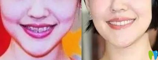 美艷性感的小S就曾做過(guò)牙齒矯正
