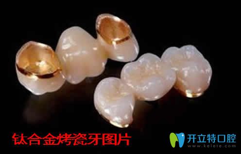 鈦合金烤瓷牙多少錢(qián)一顆  公布鈦合金烤瓷牙價(jià)格及使用壽命