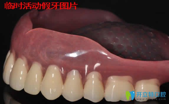 臨時活動假牙能戴多久？資深牙醫(yī)分享戴臨時假牙注意事項(xiàng)