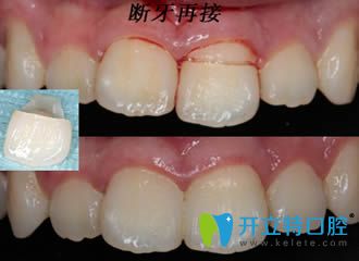 開立特口腔：牙斷了能接嗎