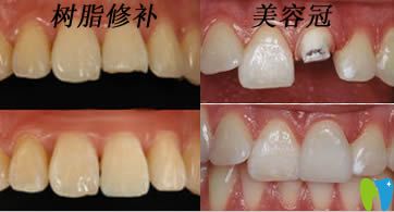 開立特口腔解答斷牙如何修復
