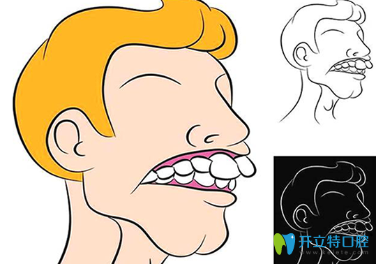 骨性齙牙通常伴有擁擠不齊，常與前牙深覆牙合