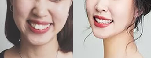 讓大家見證下我在重慶齊美口腔矯正齙牙、兔子牙511天變化