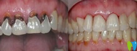 廈門亞歐齒科中心歐忠輝根管治療案例效果圖 廈門亞歐齒科中心歐忠輝根管治療案例效果圖