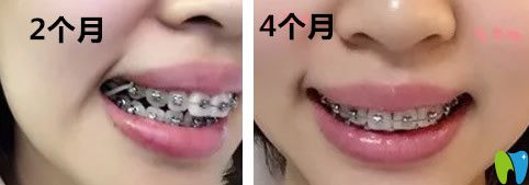重慶齊美口腔牙齒矯正2~4個月變化圖