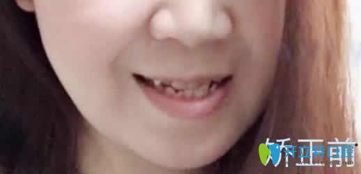 這是我虎牙擁擠在廣州穗江口腔做隱形矯正15個(gè)月臉型變化圖