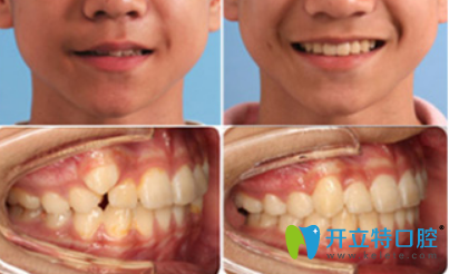 深圳河山齒科怎么樣？吳菊珍13歲少年虎牙矯正案例效果來證明
