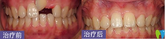 深圳烤瓷牙哪家好？鵬程口腔牙齒修復案例來嘍