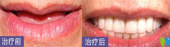 深圳哪家種植牙好？看深圳鵬程口腔種植牙案例