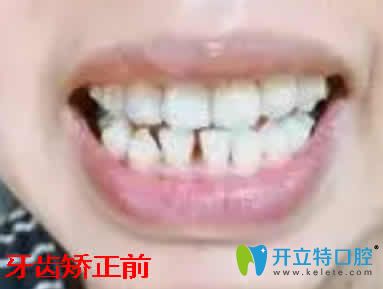 寧波正畸哪家好 用我在拜博拜爾口腔牙齒矯正效果揭曉