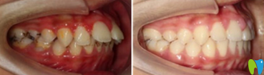 深圳河山齒科羅鵬飛怎么樣？羅鵬飛齙牙矯正案例效果來證明