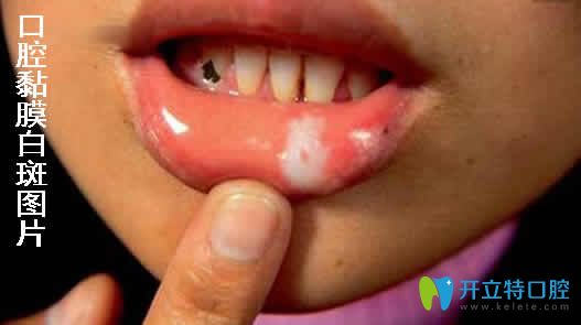 口腔黏膜白斑會自愈嗎？告訴你怎么治療及會不會癌變