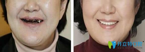 廈門宏沅膛口腔種植牙案例圖 廈門宏沅膛口腔種植牙案例圖