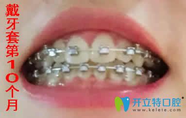 我在寧波拜博拜爾口腔做牙齒矯正10個月照片