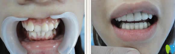 廈門宏沅膛口腔牙齒矯正前后對比圖 廈門宏沅膛口腔牙齒矯正前后對比圖