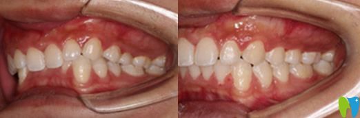 深圳河山齒科吳偉斌靠譜嗎？來看吳偉斌正畸案例