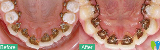 深圳牙齒正畸哪家好？鵬程口腔真人案例來驗證