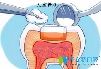 兒童補(bǔ)牙有必要嗎?另附小孩補(bǔ)牙價格和寶寶補(bǔ)牙過程圖解